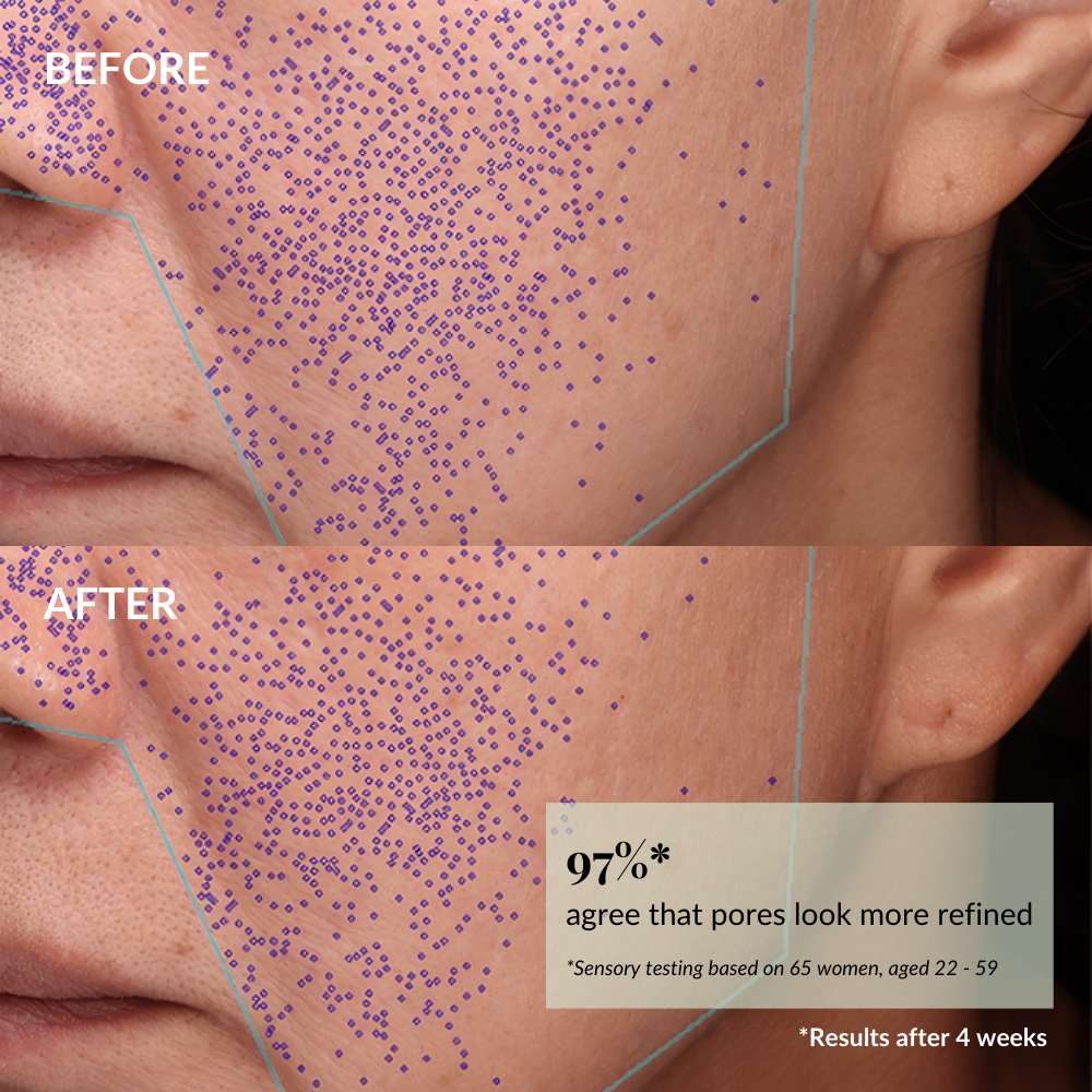 Close-up of a woman's cheek shows "before" with many purple dots and "after" with fewer, highlighting reduced skin pore visibility after 4 weeks of using IREN Shizen's START AFRESH DAILY Enzyme Powder Wash.